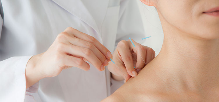 person wearing white coat inserts acupuncture needles into patient shoulder
