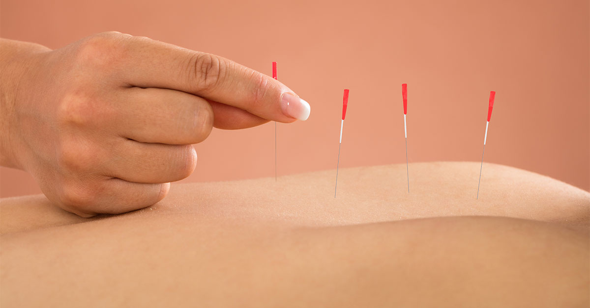 How to an Acupuncturist Natural Healers