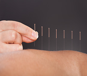 hand placing acupuncture needles into patient back