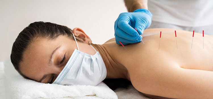 woman receiving acupuncture on back
